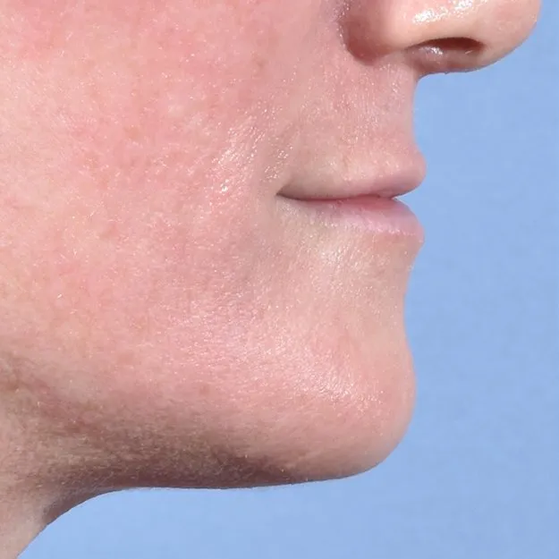 Fillers Before and After - Case 11, Image 5 - Female, age 35 – 44 - Baltimore, MD - Skin Therapeutics Med Spa