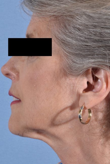 Fillers Before and After - Case 13, Image 5 - Female, age 55 – 64 - Baltimore, MD - Skin Therapeutics Med Spa