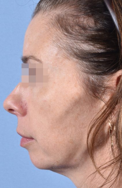 Fillers Before and After - Case 14, Image 5 - Female, age 35 – 44 - Baltimore, MD - Skin Therapeutics Med Spa