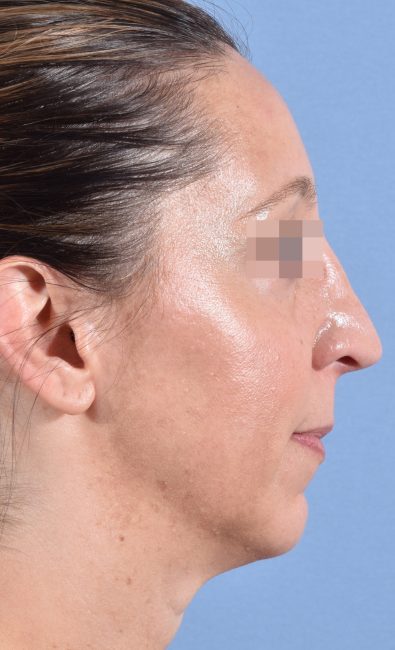 Fillers Before and After - Case 15, Image 5 - Female, age 35 – 44 - Baltimore, MD - Skin Therapeutics Med Spa