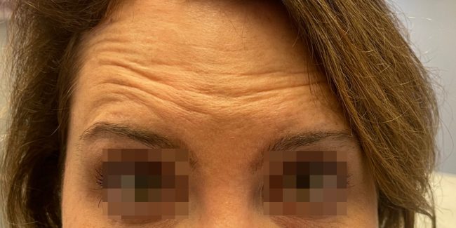 Dysport Before and After - Case 7, Image 1 - Female, age 25 – 34 - Baltimore, MD - Skin Therapeutics Med Spa