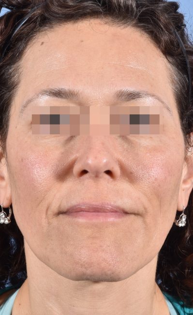 Fillers Before and After - Case 16, Image 5 - Female, age 35 – 44 - Baltimore, MD - Skin Therapeutics Med Spa