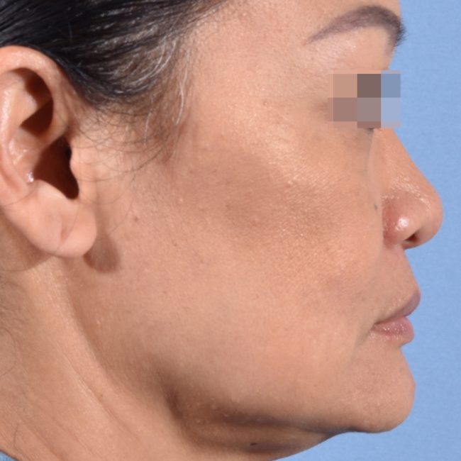 Fillers Before and After - Case 17, Image 5 - Female, age 35 – 44 - Baltimore, MD - Skin Therapeutics Med Spa