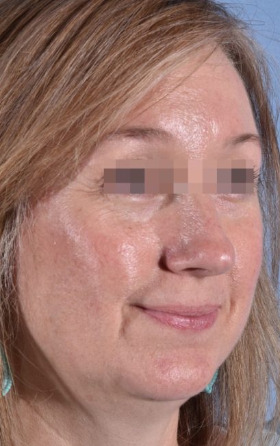 Fillers Before and After - Case 18, Image 5 - Female, age 35 – 44 - Baltimore, MD - Skin Therapeutics Med Spa