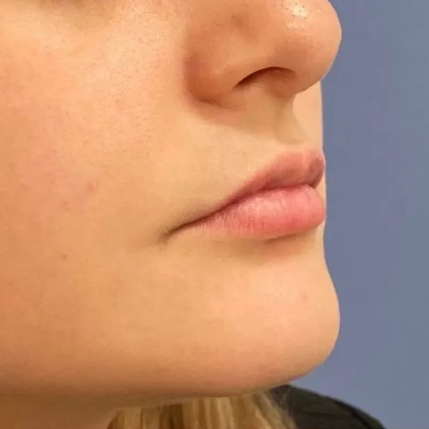 Fillers Before and After - Case 9, Image 1 - Female, age 25 – 34 - Baltimore, MD - Skin Therapeutics Med Spa