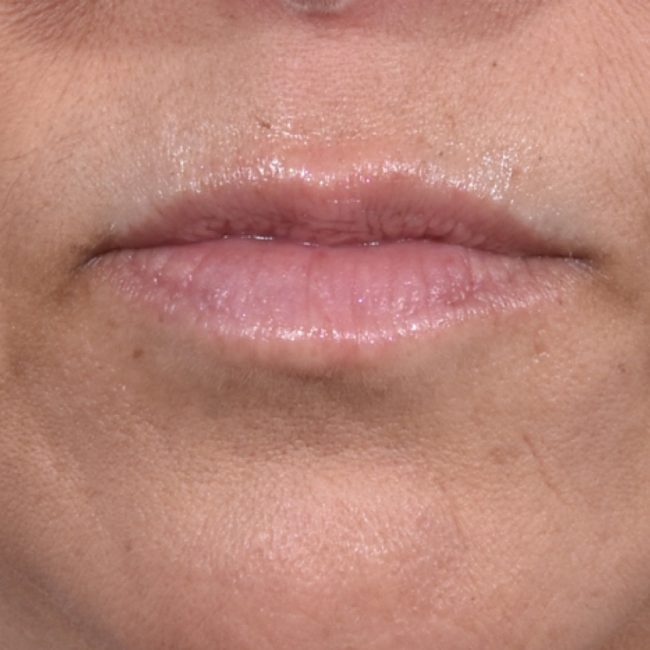 Fillers Before and After - Case 12, Image 1 - Female, age 35 – 44 - Baltimore, MD - Skin Therapeutics Med Spa