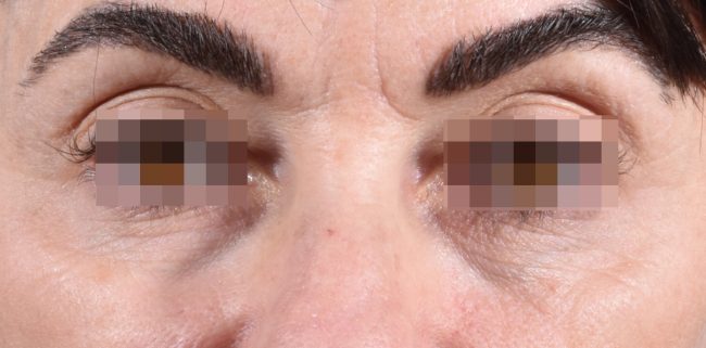 Fillers Before and After - Case 23, Image 1 - Female, age 35 – 44 - Baltimore, MD - Skin Therapeutics Med Spa