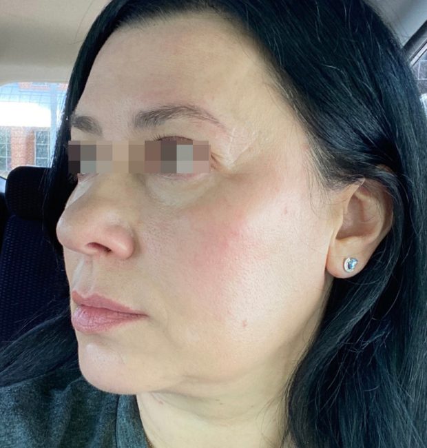 Fillers Before and After - Case 24, Image 1 - Female, age 35 – 44 - Baltimore, MD - Skin Therapeutics Med Spa