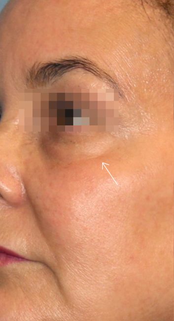 Fillers Before and After - Case 25, Image 1 - Female, age 35 – 44 - Baltimore, MD - Skin Therapeutics Med Spa