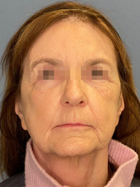 Fillers Before and After - Case 32, Image 1 - Female, age 55 – 64 - Baltimore, MD - Skin Therapeutics Med Spa