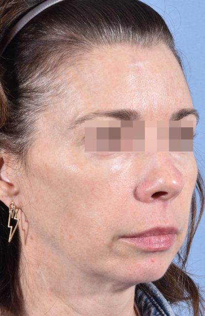 Fillers Before and After - Case 14, Image 7 - Female, age 35 – 44 - Baltimore, MD - Skin Therapeutics Med Spa