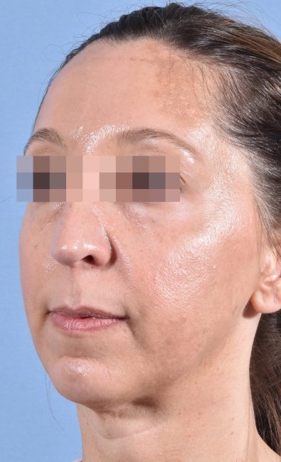 Fillers Before and After - Case 15, Image 7 - Female, age 35 – 44 - Baltimore, MD - Skin Therapeutics Med Spa