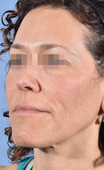 Fillers Before and After - Case 16, Image 7 - Female, age 35 – 44 - Baltimore, MD - Skin Therapeutics Med Spa