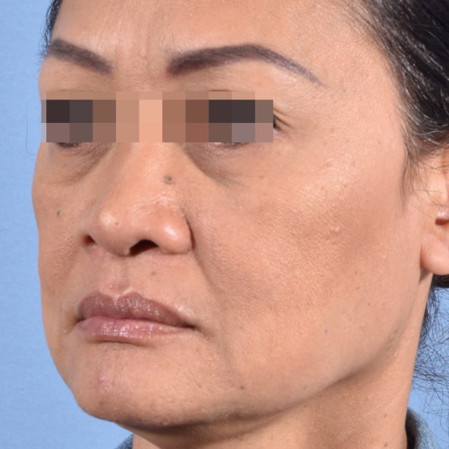 Fillers Before and After - Case 17, Image 7 - Female, age 35 – 44 - Baltimore, MD - Skin Therapeutics Med Spa