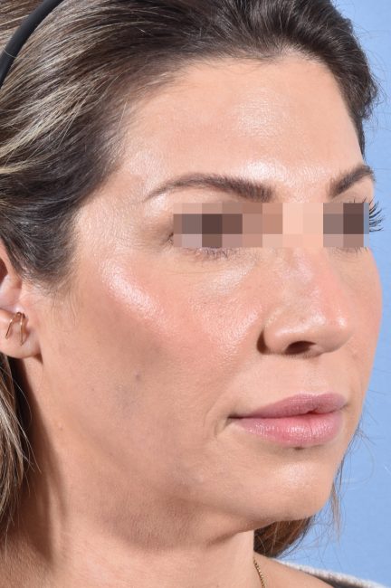 Fillers Before and After - Case 19, Image 5 - Female, age 25 – 34 - Baltimore, MD - Skin Therapeutics Med Spa