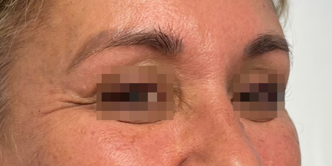 Dysport Before and After - Case 8, Image 1 - Female, age 45 – 54 - Baltimore, MD - Skin Therapeutics Med Spa