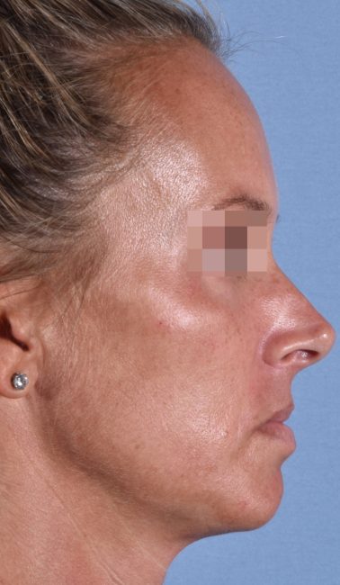 Fillers Before and After - Case 26, Image 7 - Female, age 25 – 34 - Baltimore, MD - Skin Therapeutics Med Spa