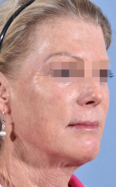 Fillers Before and After - Case 27, Image 7 - Female, age 45 – 54 - Baltimore, MD - Skin Therapeutics Med Spa