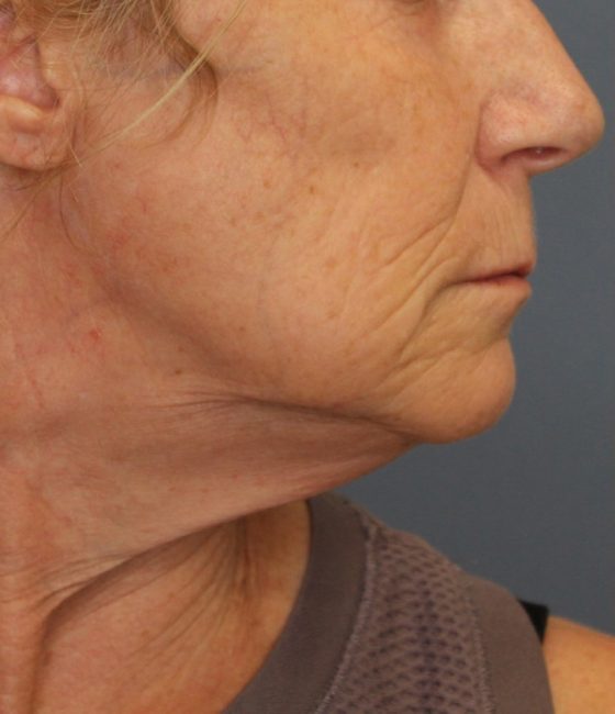 Fillers Before and After - Case 31, Image 7 - Female, age 45 – 54 - Baltimore, MD - Skin Therapeutics Med Spa