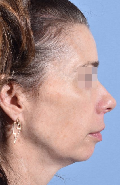 Fillers Before and After - Case 14, Image 9 - Female, age 35 – 44 - Baltimore, MD - Skin Therapeutics Med Spa