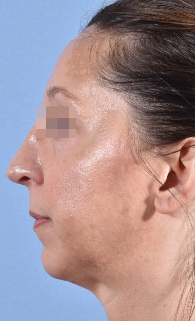 Fillers Before and After - Case 15, Image 9 - Female, age 35 – 44 - Baltimore, MD - Skin Therapeutics Med Spa