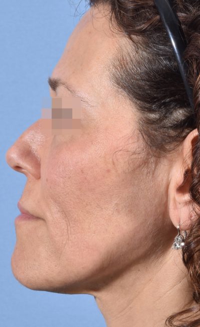 Fillers Before and After - Case 16, Image 9 - Female, age 35 – 44 - Baltimore, MD - Skin Therapeutics Med Spa