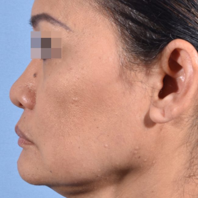 Fillers Before and After - Case 17, Image 9 - Female, age 35 – 44 - Baltimore, MD - Skin Therapeutics Med Spa