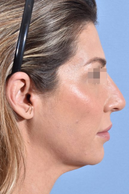 Fillers Before and After - Case 19, Image 9 - Female, age 25 – 34 - Baltimore, MD - Skin Therapeutics Med Spa