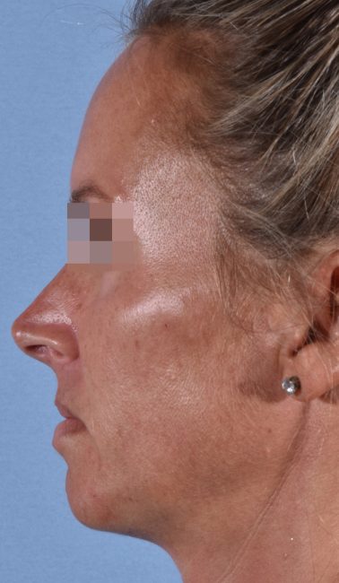 Fillers Before and After - Case 26, Image 9 - Female, age 25 – 34 - Baltimore, MD - Skin Therapeutics Med Spa