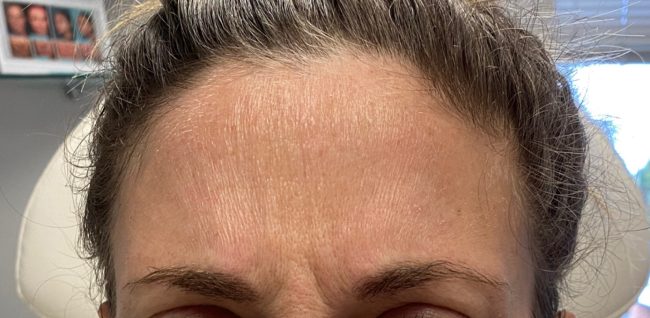 Botox Before and After - Case 9, Image 1 - Female, age 25 – 34 - Baltimore, MD - Skin Therapeutics Med Spa