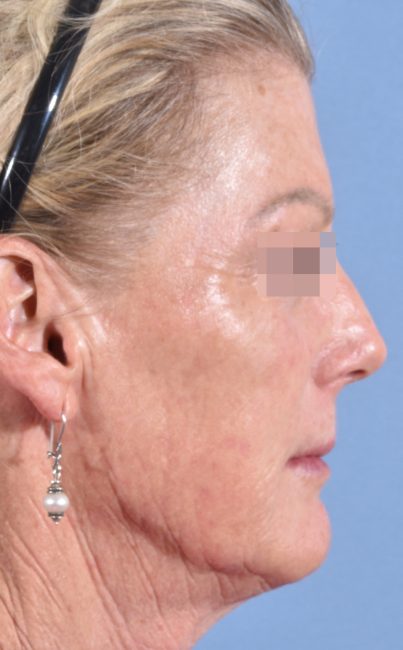 Fillers Before and After - Case 27, Image 9 - Female, age 45 – 54 - Baltimore, MD - Skin Therapeutics Med Spa