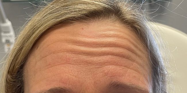 Botox Before and After - Case 8, Image 1 - Female, age 35 – 44 - Baltimore, MD - Skin Therapeutics Med Spa