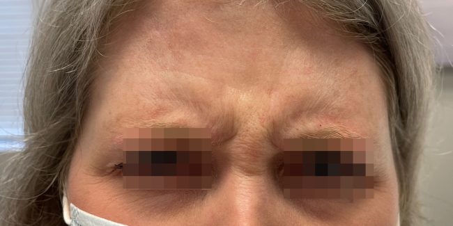 Dysport Before and After - Case 9, Image 1 - Female, age 35 – 44 - Baltimore, MD - Skin Therapeutics Med Spa