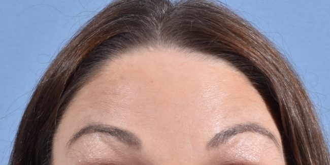 Botox Before and After - Case 5, Image 1 - Female, age 35 – 44 - Baltimore, MD - Skin Therapeutics Med Spa