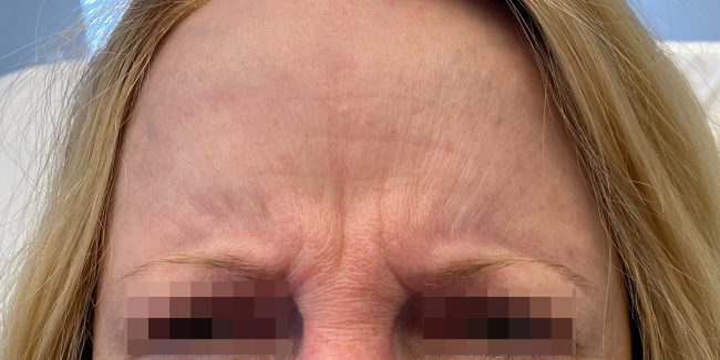 Botox Before and After - Case 6, Image 1 - Female, age 45 – 54 - Baltimore, MD - Skin Therapeutics Med Spa