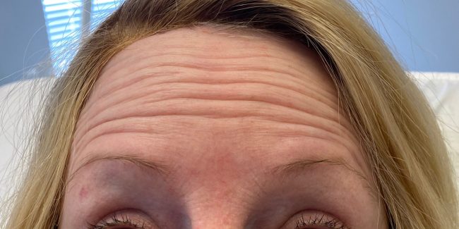 Botox Before and After - Case 6, Image 3 - Female, age 45 – 54 - Baltimore, MD - Skin Therapeutics Med Spa