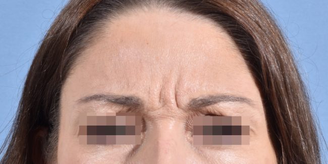 Botox Before and After - Case 5, Image 3 - Female, age 35 – 44 - Baltimore, MD - Skin Therapeutics Med Spa