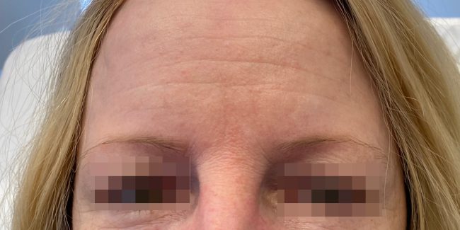 Botox Before and After - Case 6, Image 5 - Female, age 45 – 54 - Baltimore, MD - Skin Therapeutics Med Spa