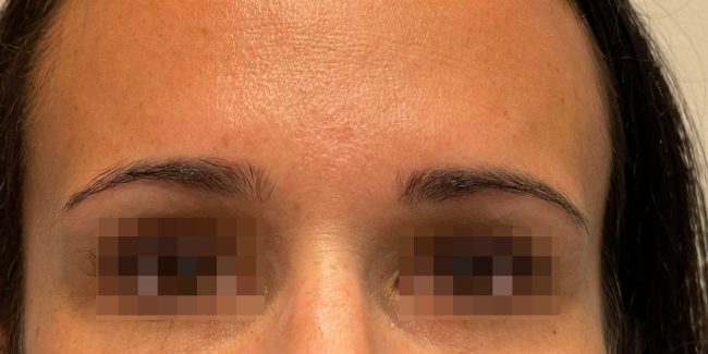 Botox Before and After - Case 7, Image 3 - Female, age 35 – 44 - Baltimore, MD - Skin Therapeutics Med Spa