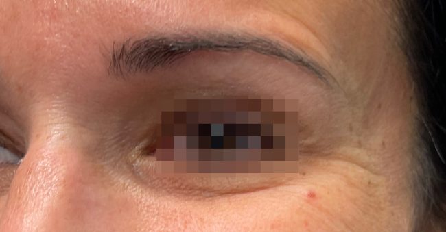 Botox Before and After - Case 7, Image 1 - Female, age 35 – 44 - Baltimore, MD - Skin Therapeutics Med Spa