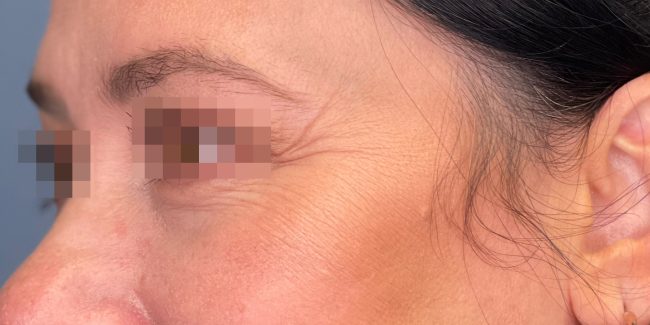 Dysport Before and After - Case 2, Image 1 - Female, age 35 – 44 - Baltimore, MD - Skin Therapeutics Med Spa