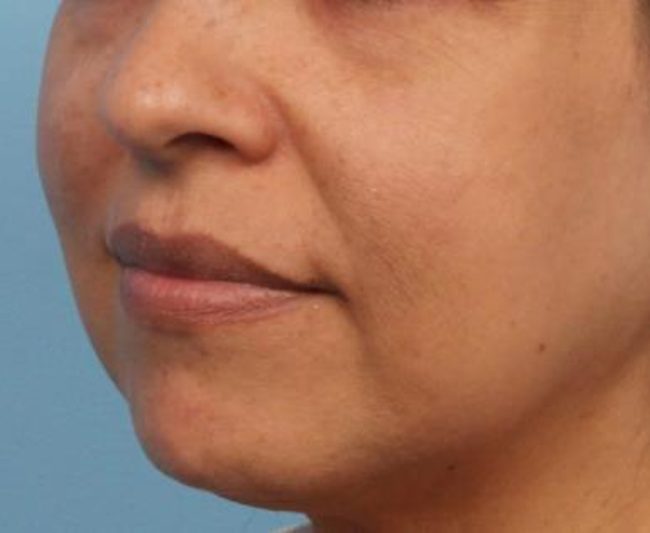 Spectra Before and After - Case 2, Image 2 - Female, age 35 – 44 - Baltimore, MD - Skin Therapeutics Med Spa