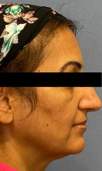 Fillers Before and After - Case 35, Image 2 - Female, age 45 – 54 - Baltimore, MD - Skin Therapeutics Med Spa