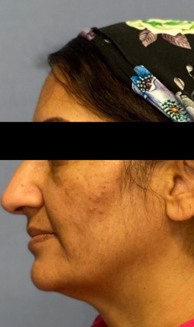 Fillers Before and After - Case 35, Image 4 - Female, age 45 – 54 - Baltimore, MD - Skin Therapeutics Med Spa