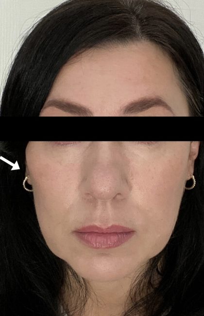 Fillers Before and After - Case 36, Image 2 - Female, age 35 – 44 - Baltimore, MD - Skin Therapeutics Med Spa