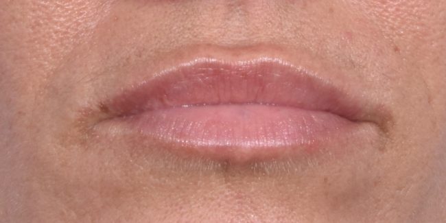 Fillers Before and After - Case 37, Image 2 - Female, age 25 – 34 - Baltimore, MD - Skin Therapeutics Med Spa