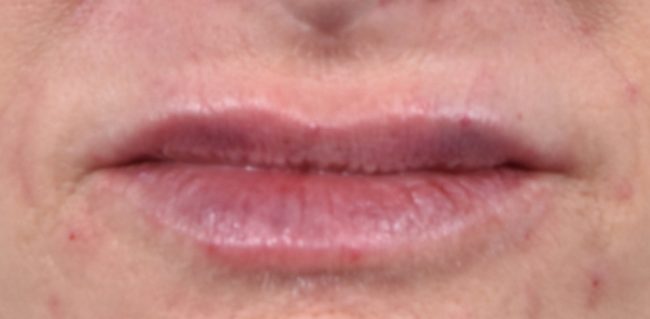 Fillers Before and After - Case 38, Image 2 - Female, age 35 – 44 - Baltimore, MD - Skin Therapeutics Med Spa