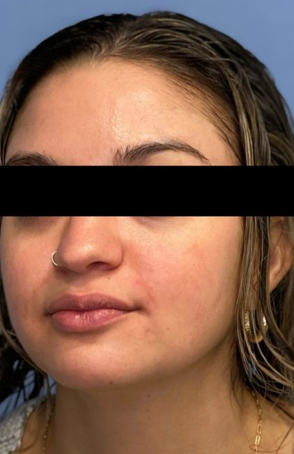 Fillers Before and After - Case 41, Image 2 - Female, age 18 – 24 - Baltimore, MD - Skin Therapeutics Med Spa