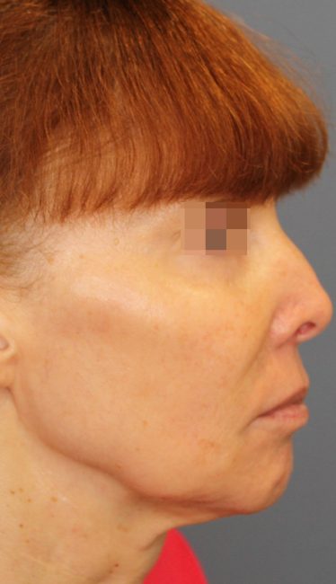 Fillers Before and After - Case 44, Image 4 - Female, age 35 – 44 - Baltimore, MD - Skin Therapeutics Med Spa