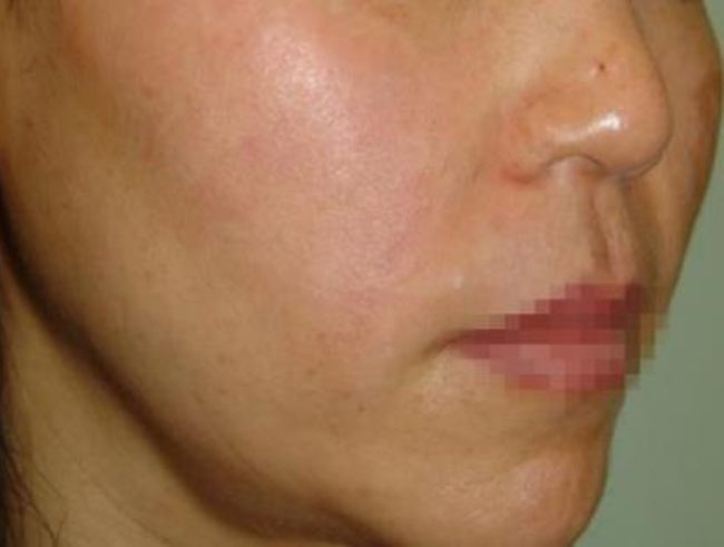 Spectra Before and After - Case 3, Image 2 - Female, age 25 – 34 - Baltimore, MD - Skin Therapeutics Med Spa